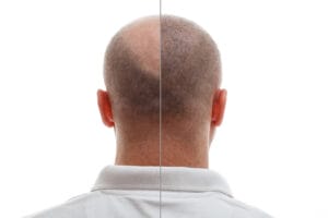 caduta, capelli, dna, trapianto, shampoo, anticaduta, reduttasi, telogen, anagen, balsamo, aminexil, minoxidil, ricrescita